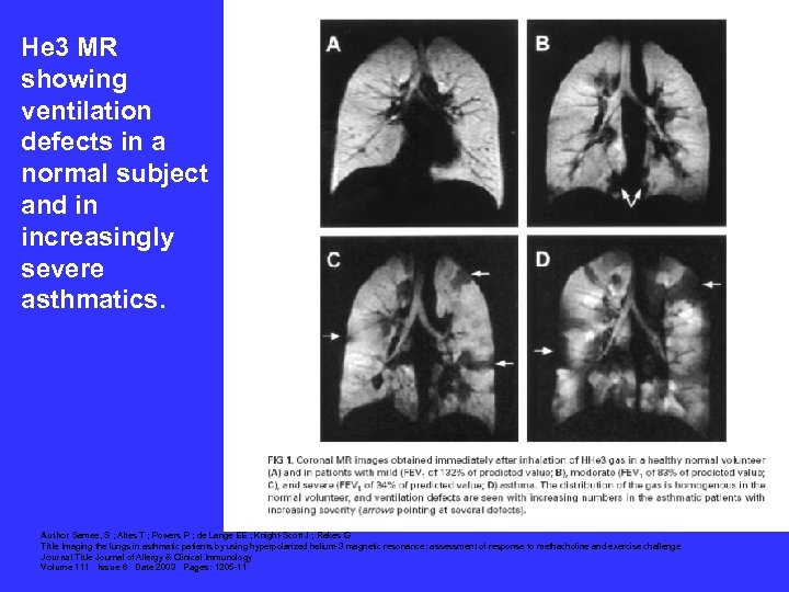 He 3 MR showing ventilation defects in a normal subject and in increasingly severe