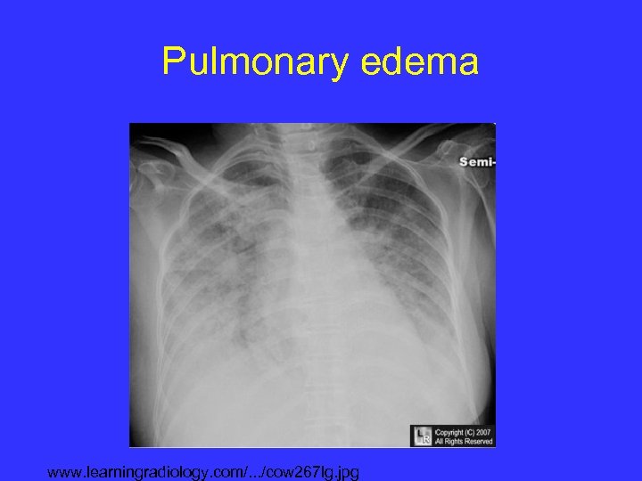 Pulmonary edema www. learningradiology. com/. . . /cow 267 lg. jpg 