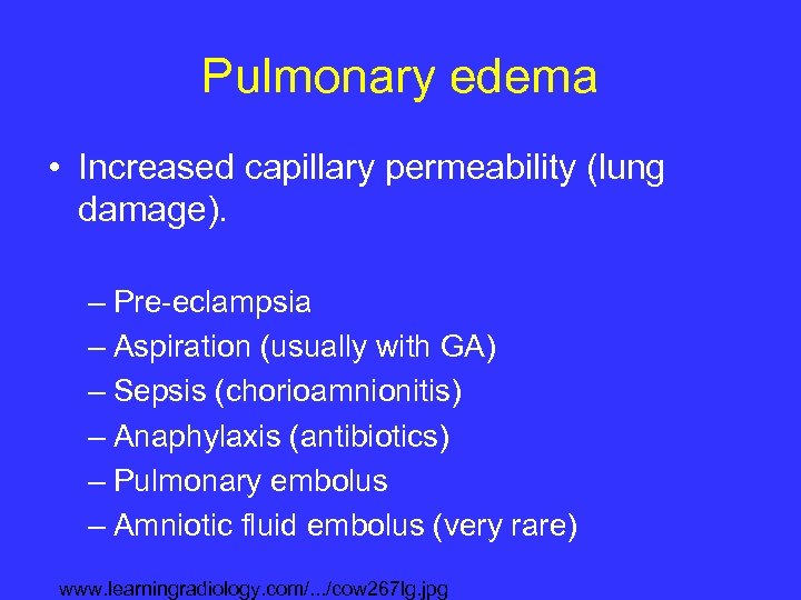 Pulmonary edema • Increased capillary permeability (lung damage). – Pre-eclampsia – Aspiration (usually with