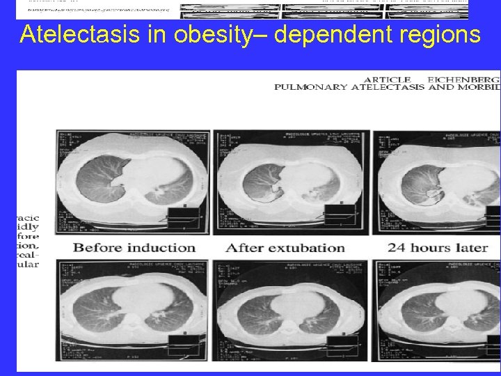 Atelectasis in obesity– dependent regions 