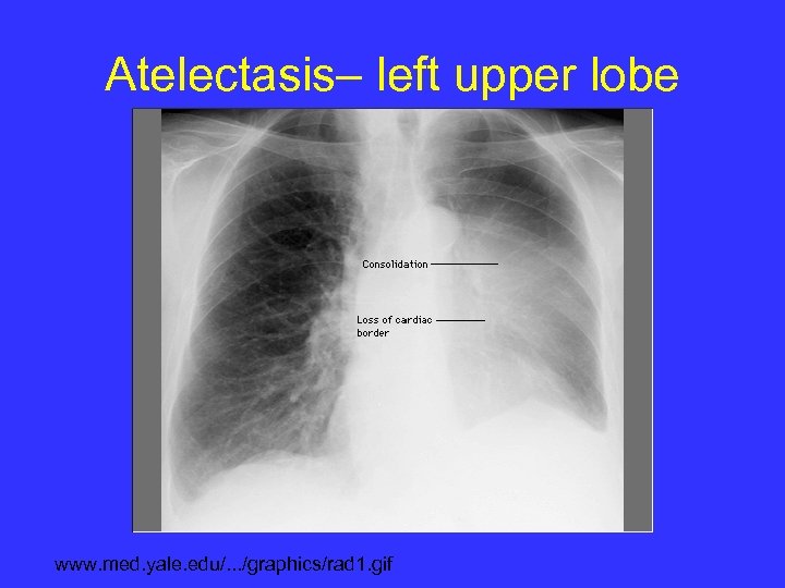 Atelectasis– left upper lobe www. med. yale. edu/. . . /graphics/rad 1. gif 