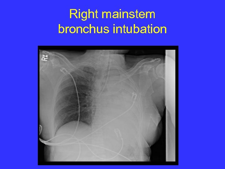 Right mainstem bronchus intubation 