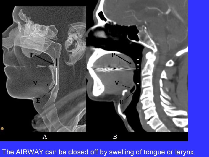 The AIRWAY can be closed off by swelling of tongue or larynx. 