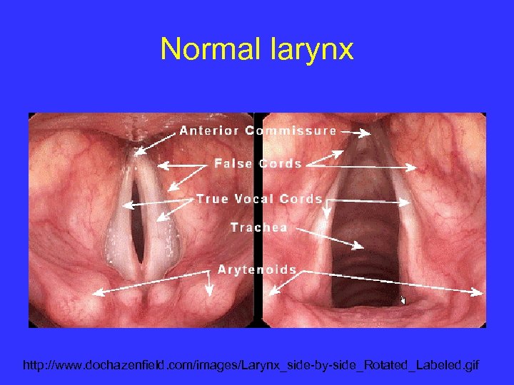 Normal larynx http: //www. dochazenfield. com/images/Larynx_side-by-side_Rotated_Labeled. gif 