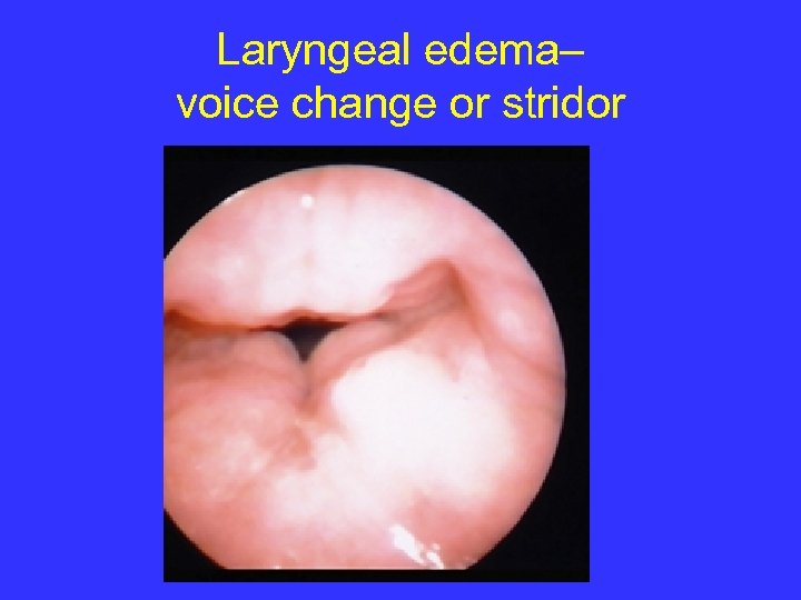 Laryngeal edema– voice change or stridor 