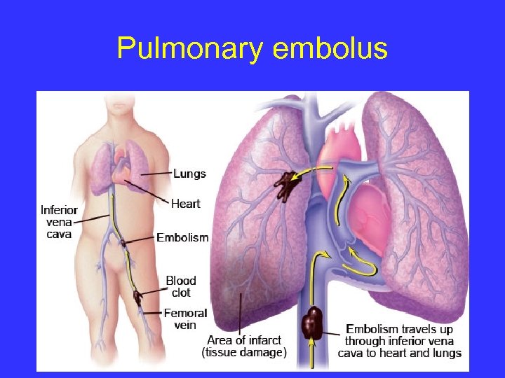 Pulmonary embolus 