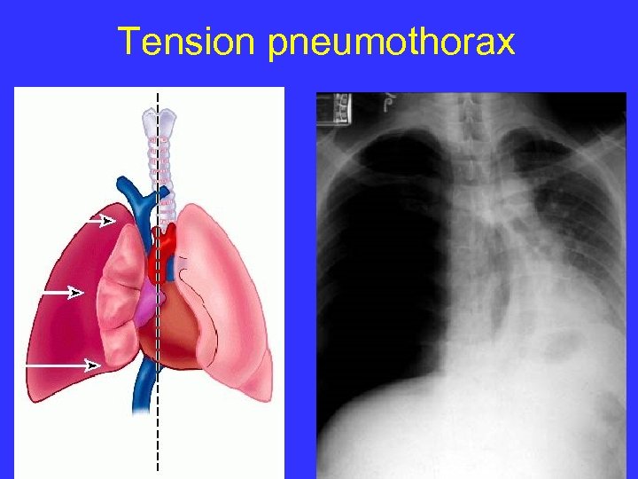 Tension pneumothorax 
