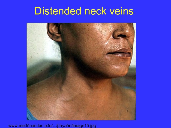 Distended neck veins www. meddean. luc. edu/. . . /phyabn/image 15. jpg 