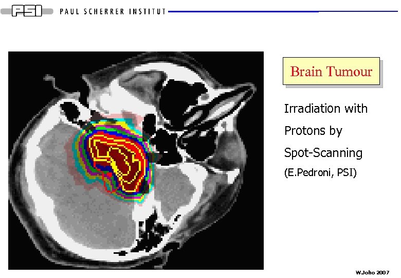 Brain Tumour Irradiation with Protons by Spot-Scanning (E. Pedroni, PSI) W. Joho 2007 