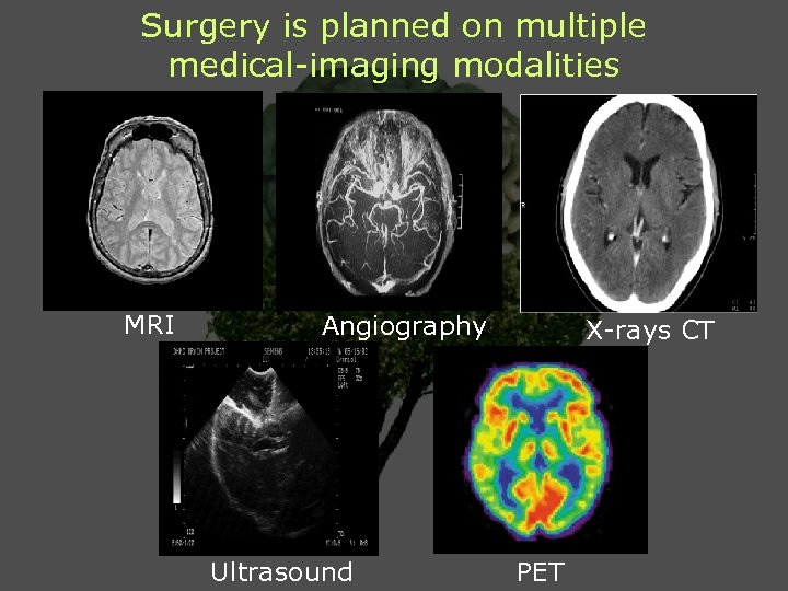 Surgery is planned on multiple medical-imaging modalities MRI Angiography Ultrasound X-rays CT PET 