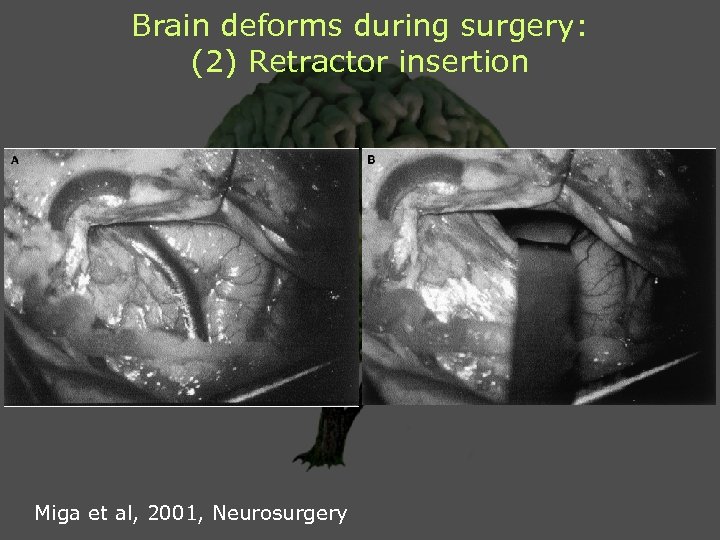 Brain deforms during surgery: (2) Retractor insertion Miga et al, 2001, Neurosurgery 