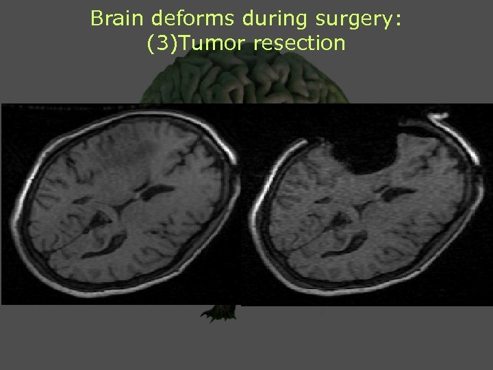 Brain deforms during surgery: (3)Tumor resection 