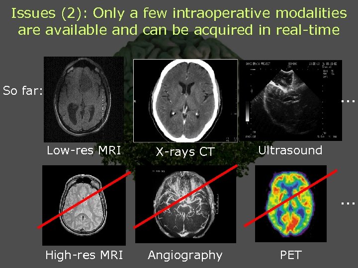 Issues (2): Only a few intraoperative modalities are available and can be acquired in