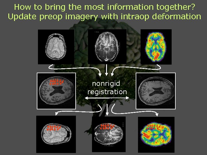 How to bring the most information together? Update preop imagery with intraop deformation nonrigid
