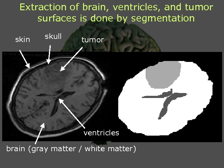 Extraction of brain, ventricles, and tumor surfaces is done by segmentation skin skull tumor