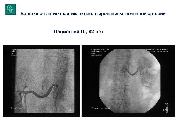 Баллонная ангиопластика со стентированием почечной артерии Пациентка Л. , 82 лет 