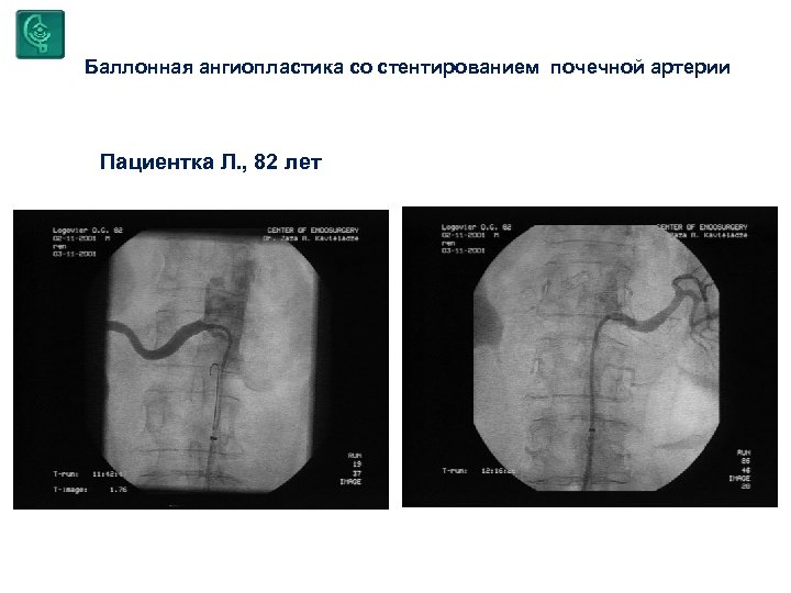 Баллонная ангиопластика со стентированием почечной артерии Пациентка Л. , 82 лет 