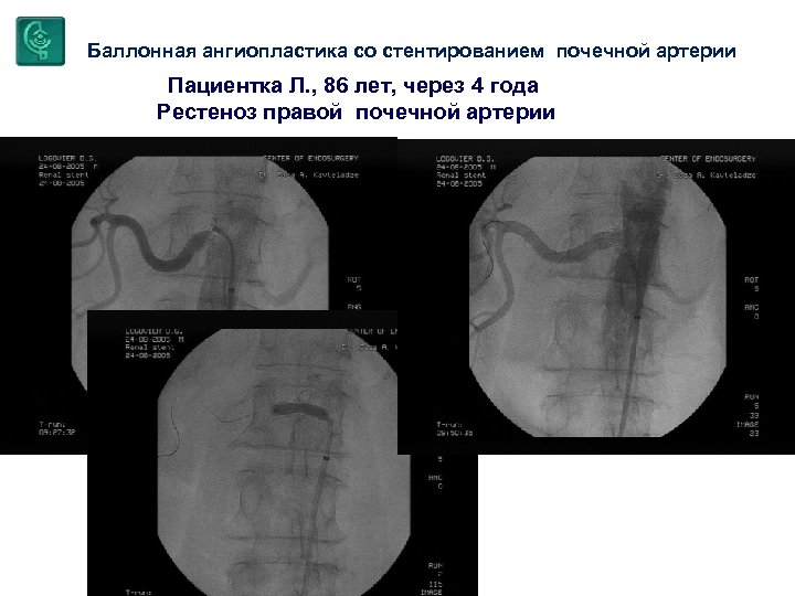 Баллонная ангиопластика со стентированием почечной артерии Пациентка Л. , 86 лет, через 4 года