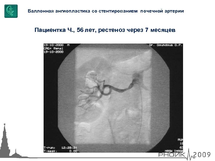 Баллонная ангиопластика со стентированием почечной артерии Пациентка Ч. , 56 лет, рестеноз через 7