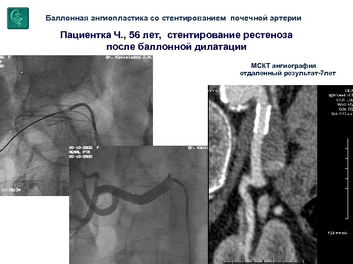Баллонная ангиопластика со стентированием почечной артерии Пациентка Ч. , 56 лет, стентирование рестеноза после