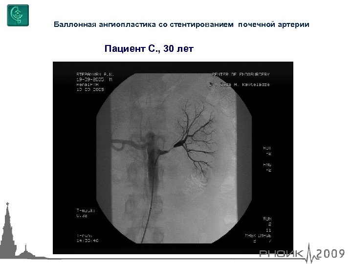 Баллонная ангиопластика со стентированием почечной артерии Пациент С. , 30 лет 