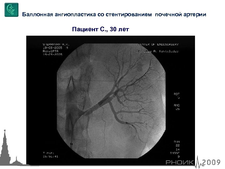 Баллонная ангиопластика со стентированием почечной артерии Пациент С. , 30 лет 
