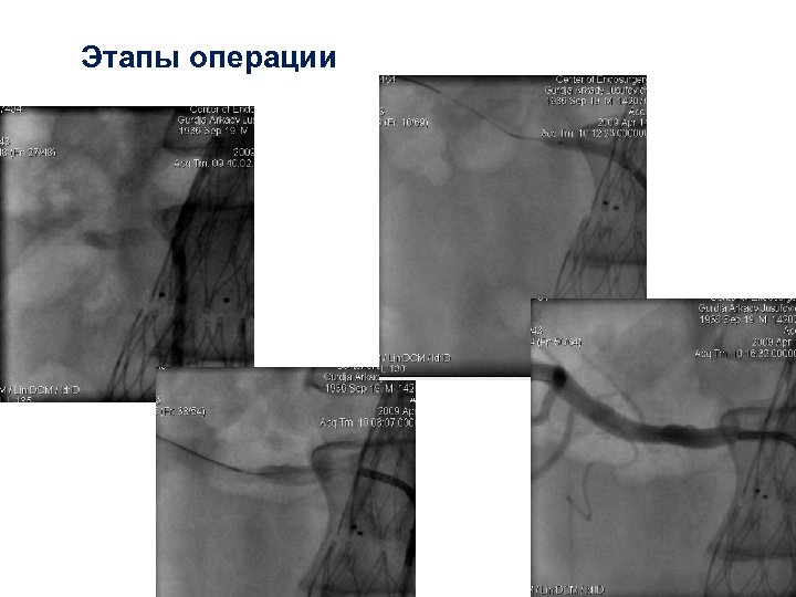 “Этапы операции 