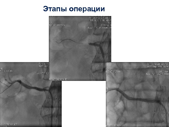 Этапы операции 