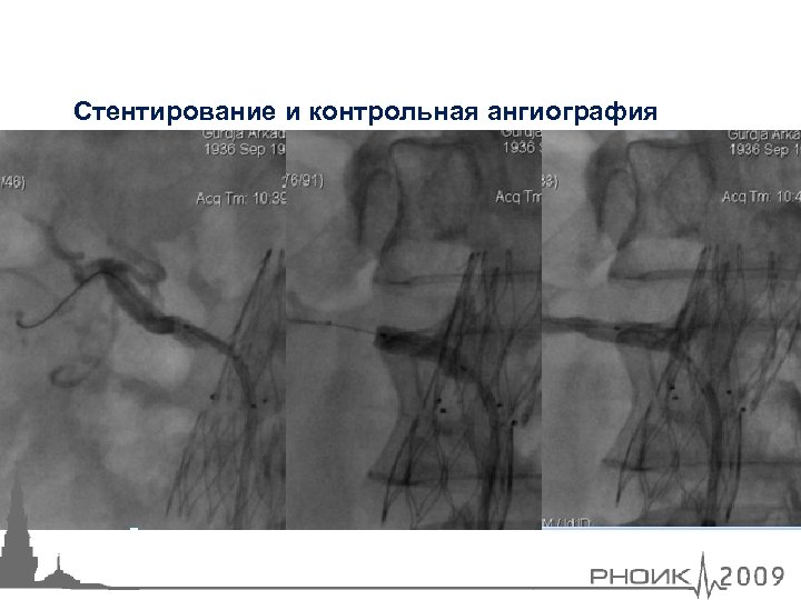 Стентирование и контрольная ангиография 