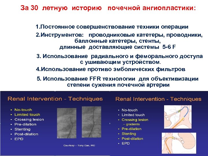 За 30 летную историю почечной ангиопластики: 1. Постоянное совершенствование техники операции 2. Инструментов: проводниковые