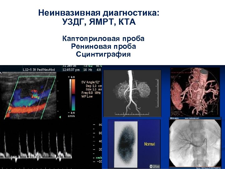 Неинвазивная диагностика: УЗДГ, ЯМРТ, КТА Каптоприловая проба Рениновая проба Сцинтиграфия 