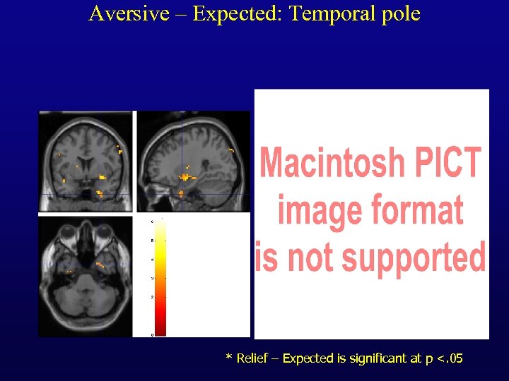 Aversive – Expected: Temporal pole * Relief – Expected is significant at p <.