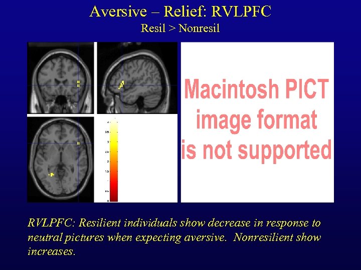 Aversive – Relief: RVLPFC Resil > Nonresil RVLPFC: Resilient individuals show decrease in response