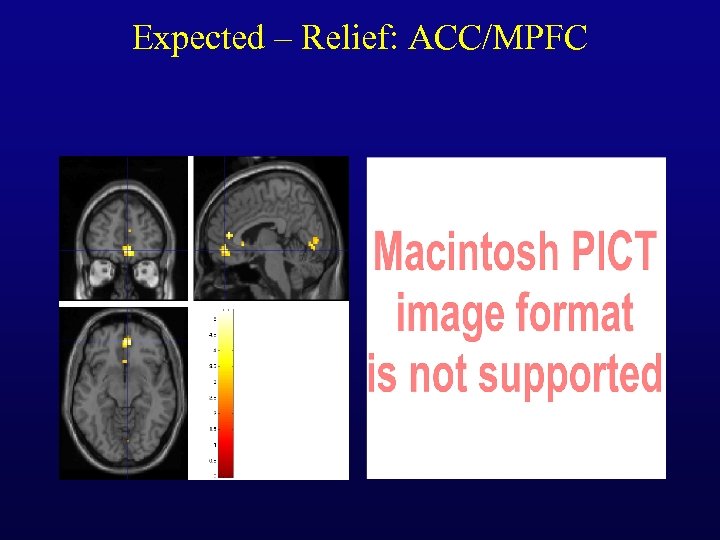 Expected – Relief: ACC/MPFC 