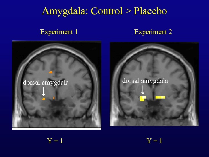 Amygdala: Control > Placebo Experiment 1 dorsal amygdala Y=1 Experiment 2 dorsal amygdala Y=1
