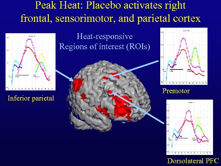 Peak Heat: Placebo activates right frontal, sensorimotor, and parietal cortex Heat-responsive Regions of interest