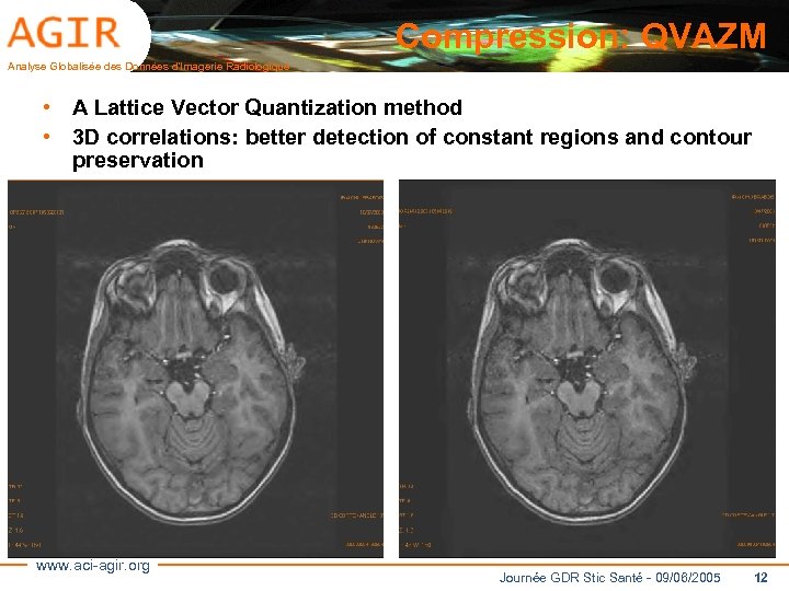 Compression: QVAZM Analyse Globalisée des Données d’Imagerie Radiologique • A Lattice Vector Quantization method