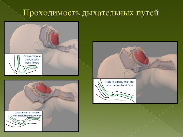 Проходимость дыхательных путей 