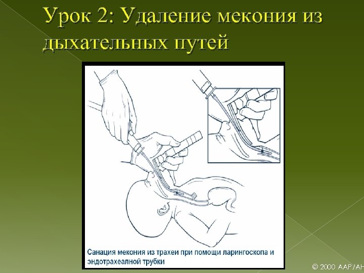 Урок 2: Удаление мекония из дыхательных путей © 2000 AAP/AH 