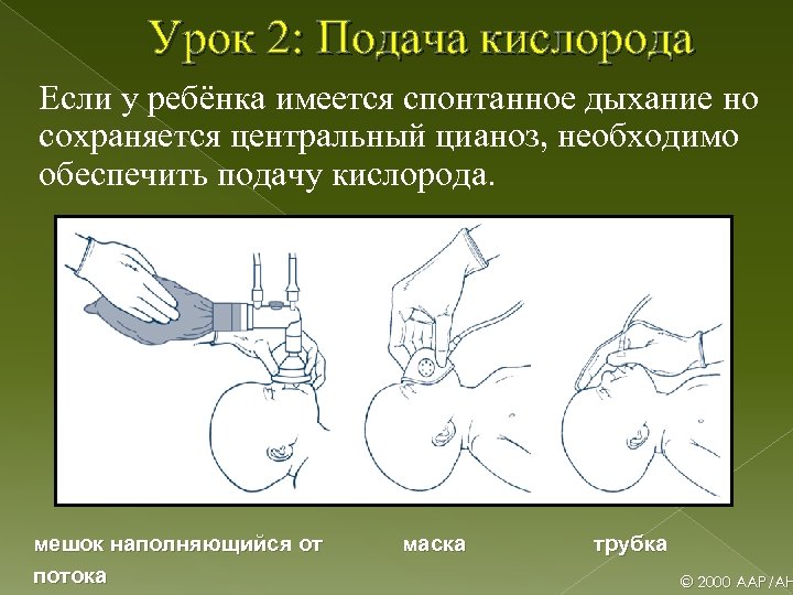 Урок 2: Подача кислорода Если у ребёнка имеется спонтанное дыхание но сохраняется центральный цианоз,