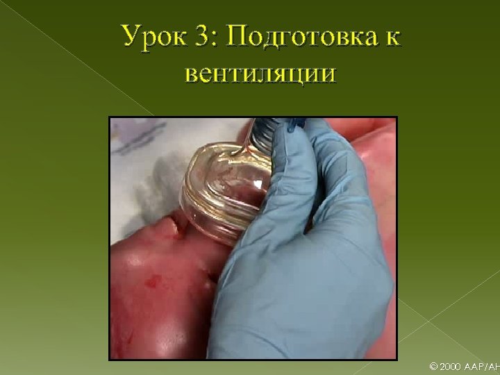 Урок 3: Подготовка к вентиляции © 2000 AAP/AH 