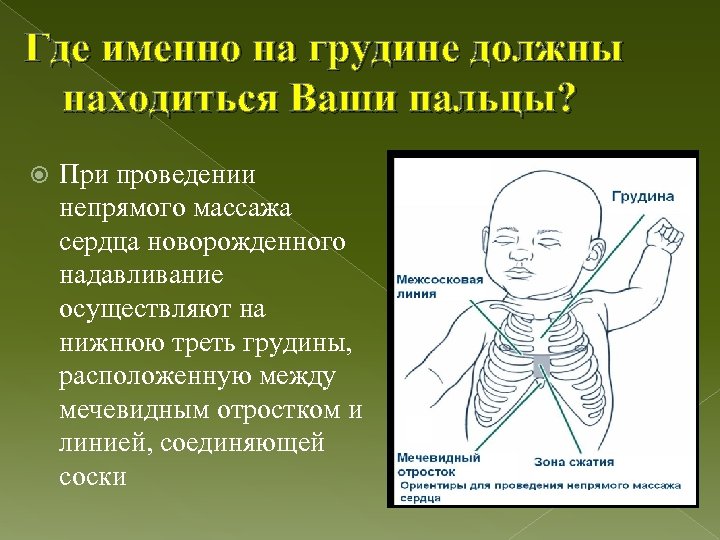 Нижняя треть грудины. При проведении непрямого массажа сердца новорожденным детям. Точка надавливания на грудину при непрямом массаже сердца. Осуществление непрямого массажа сердца у новорожденных. Надавливание на грудину новорожденного.