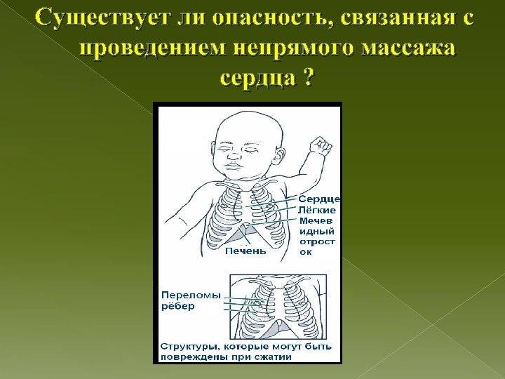 Существует ли опасность, связанная с проведением непрямого массажа сердца ? 