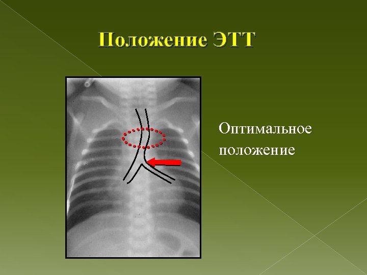 Положение ЭТТ Оптимальное положение 