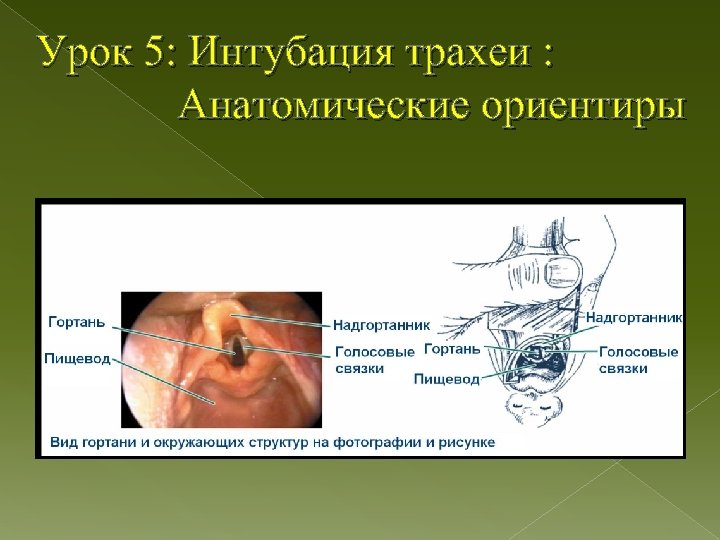 Интубация трахеи презентация