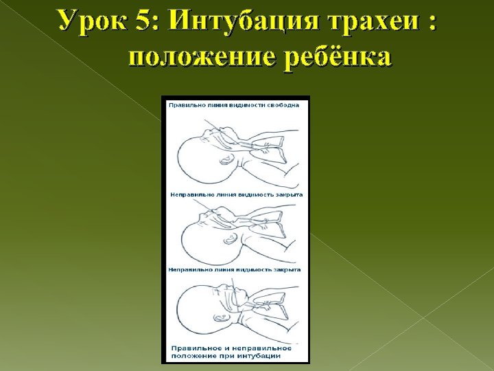 Урок 5: Интубация трахеи : положение ребёнка 