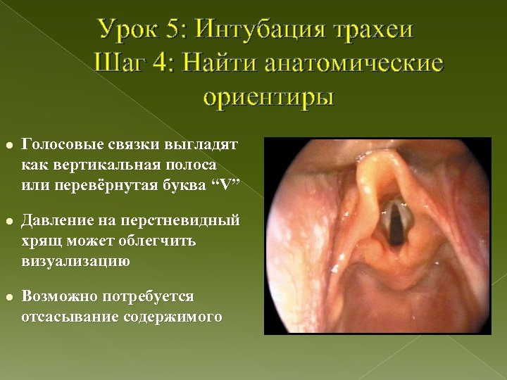 Урок 5: Интубация трахеи Шаг 4: Найти анатомические ориентиры l Голосовые связки выгладят как