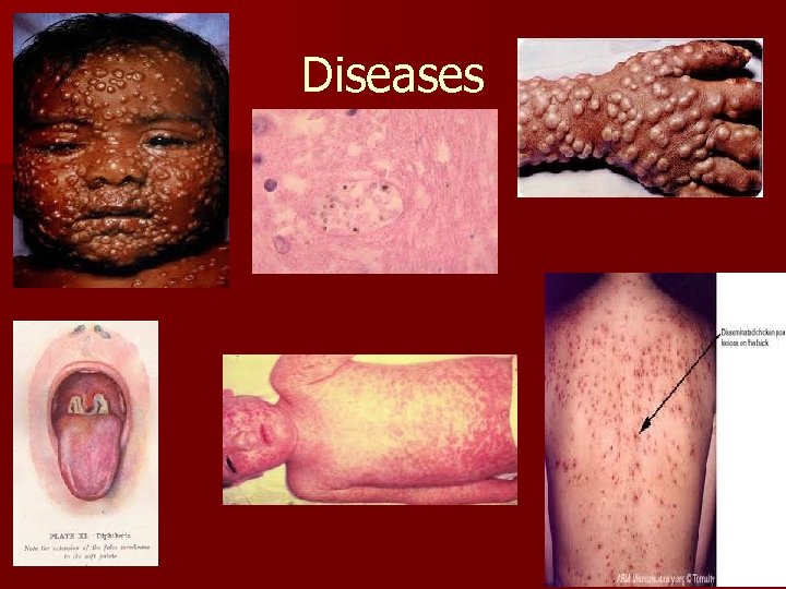 Diseases 