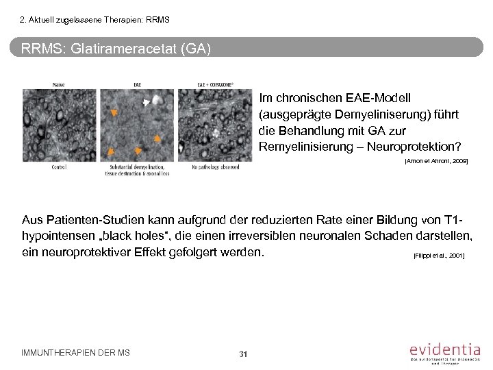 2. Aktuell zugelassene Therapien: RRMS: Glatirameracetat (GA) Im chronischen EAE-Modell (ausgeprägte Demyeliniserung) führt die