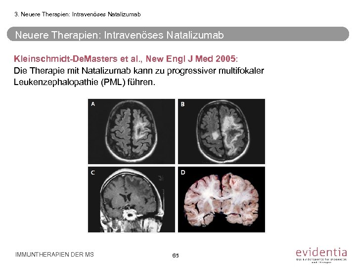 3. Neuere Therapien: Intravenöses Natalizumab Kleinschmidt-De. Masters et al. , New Engl J Med